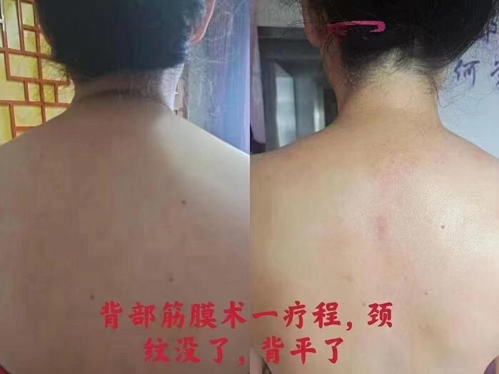 瘦身案例