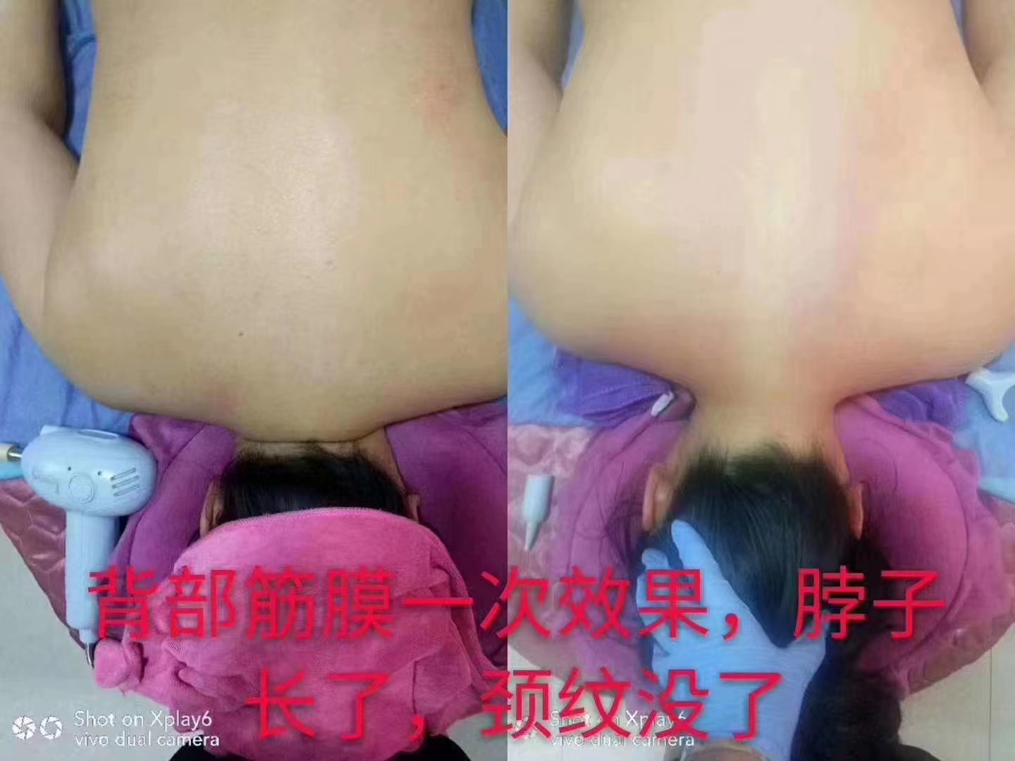 筋膜術案例